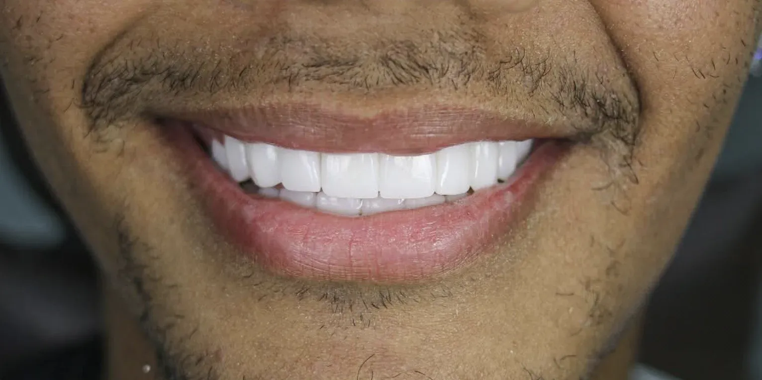 Zirconium Crowns before-after6