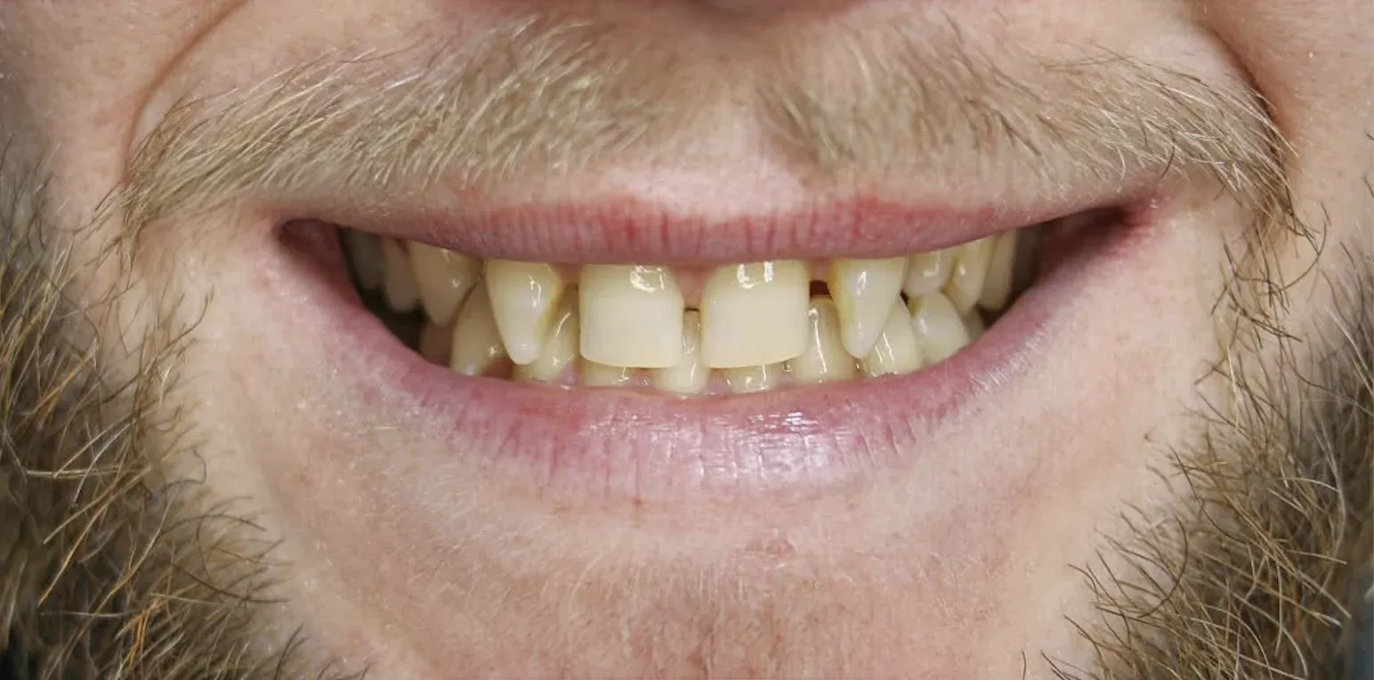 Zirconium Crowns before-after7