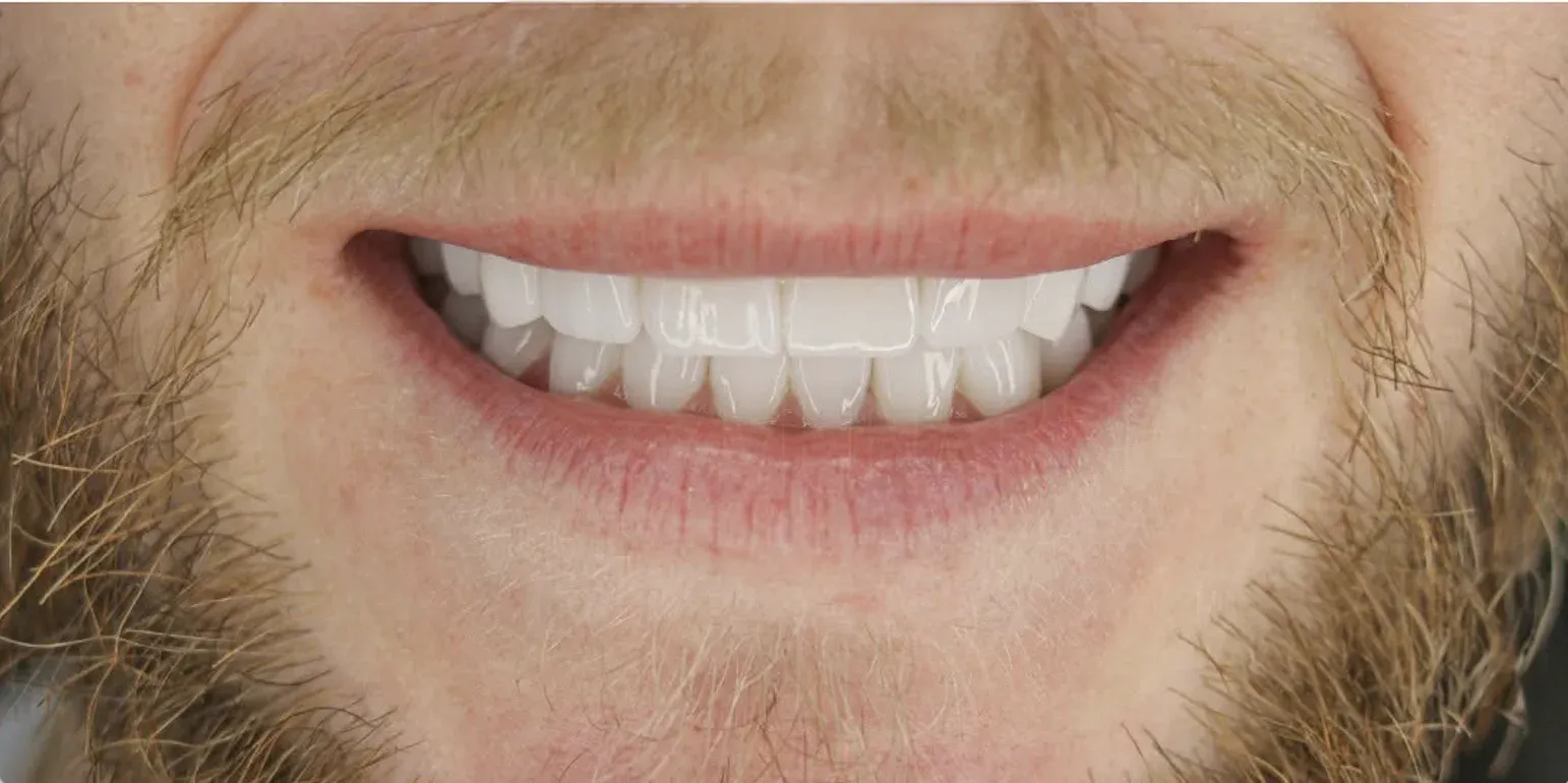 Zirconium Crowns before-after8