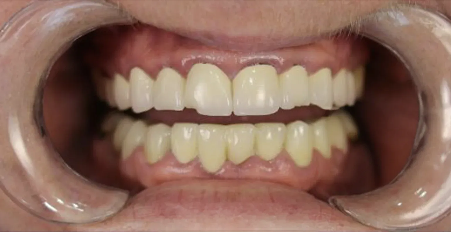 Zirconium Crowns before-after9