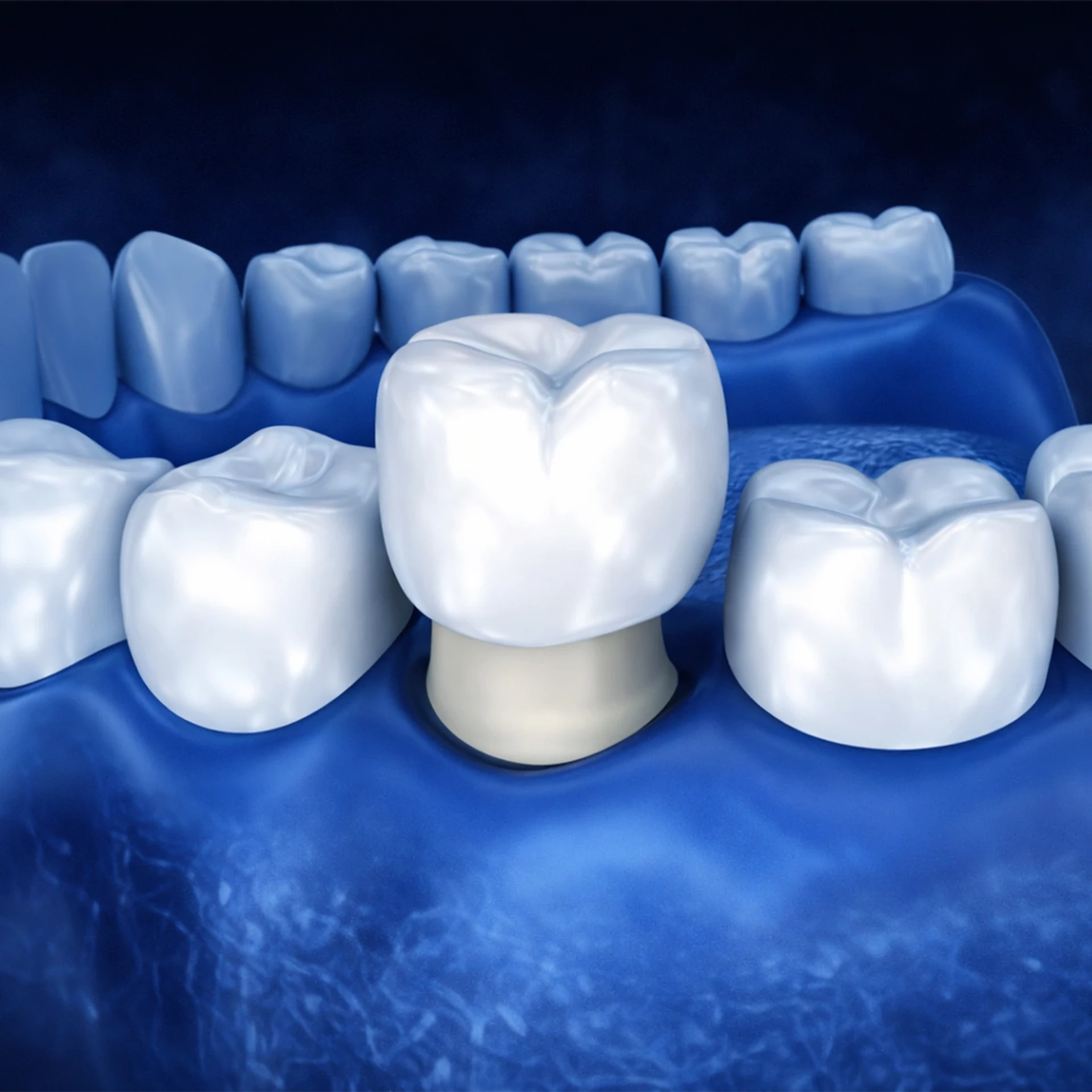 Quanto durano le corone in zirconio