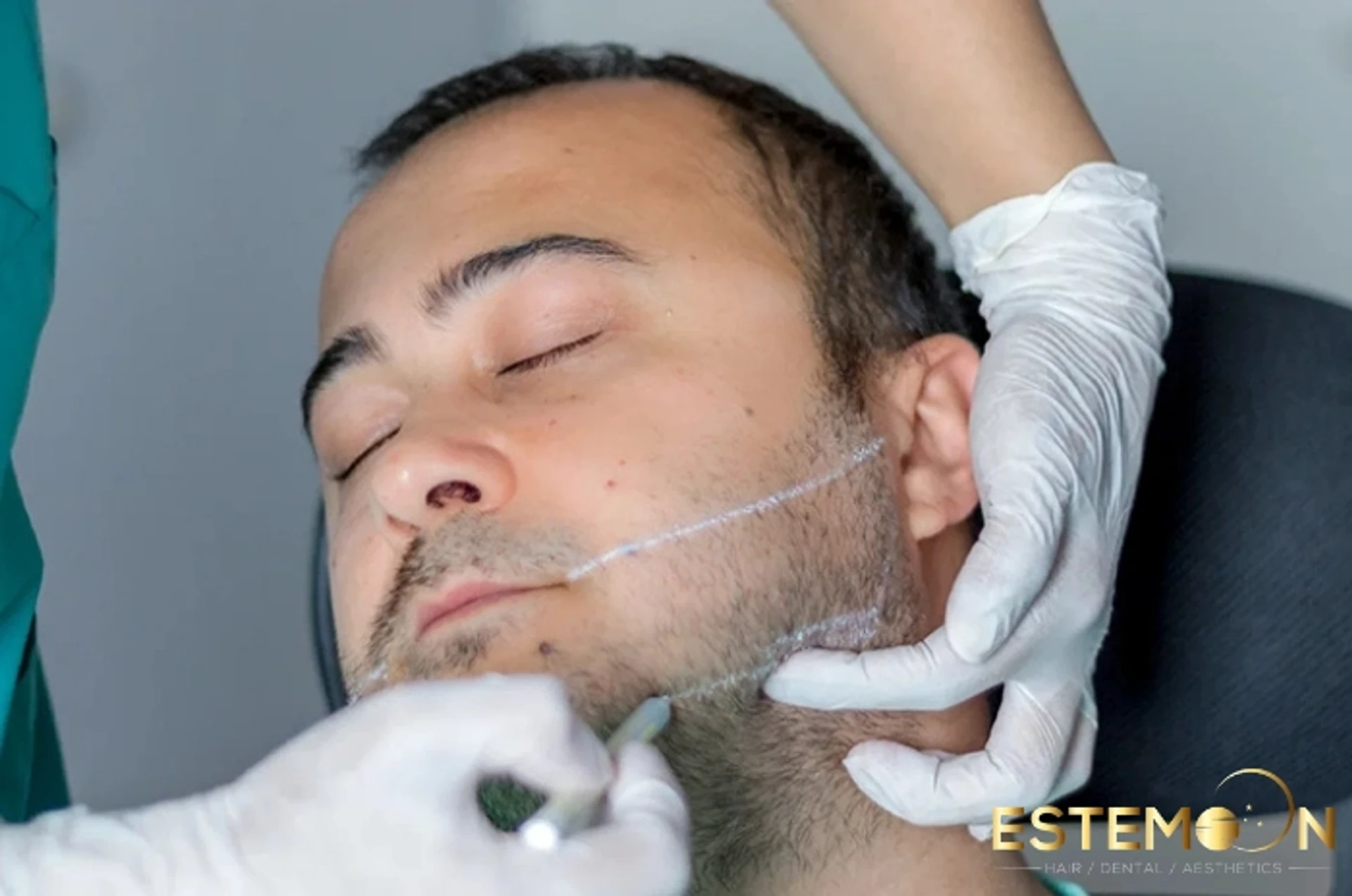 trapianto di barba in tacchino