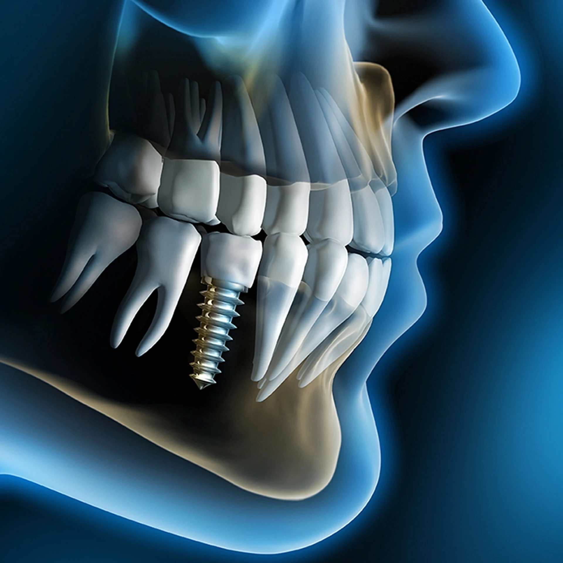 CHE COS'È UN IMPIANTO DENTALE?