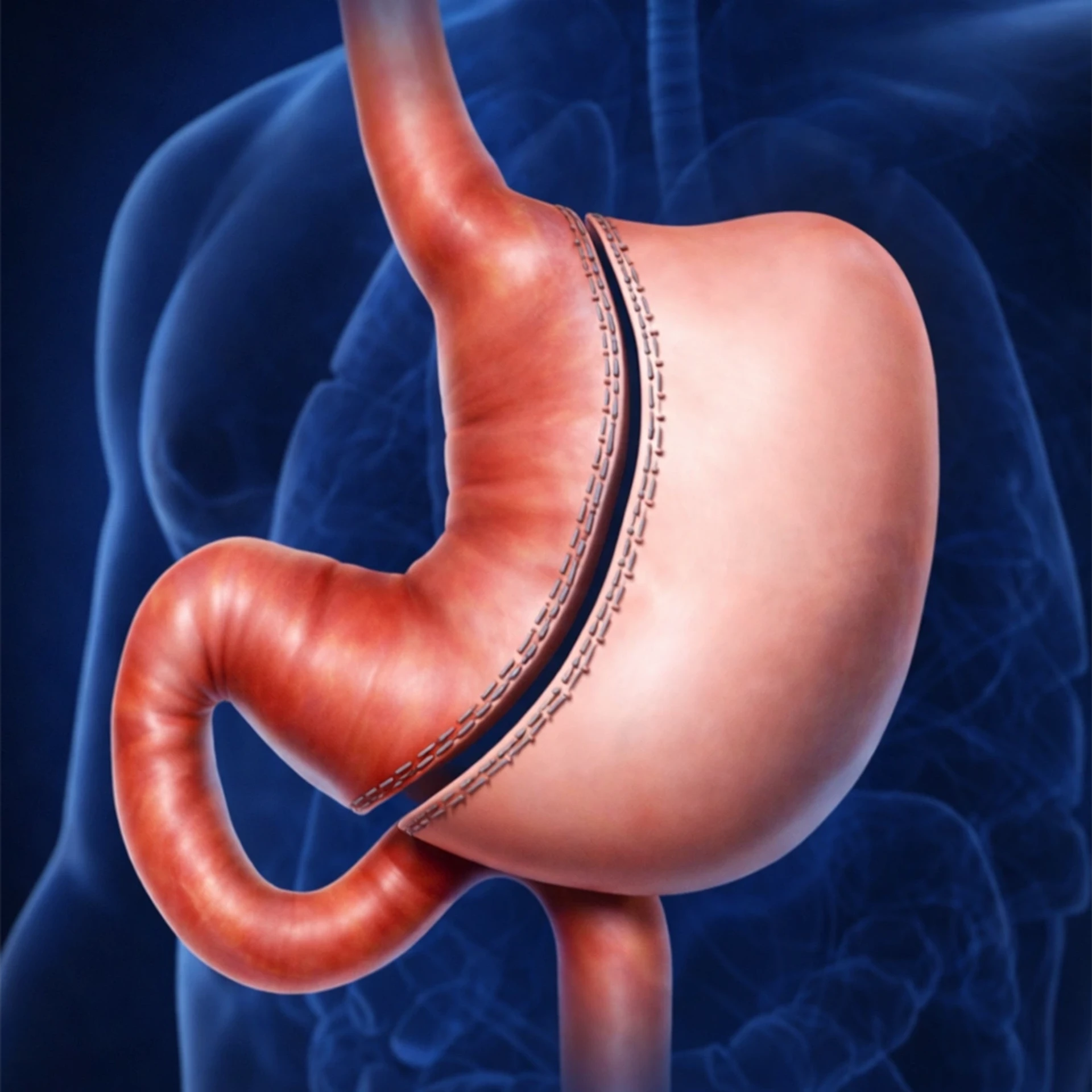 Cos'è la gastrosectomia a manica