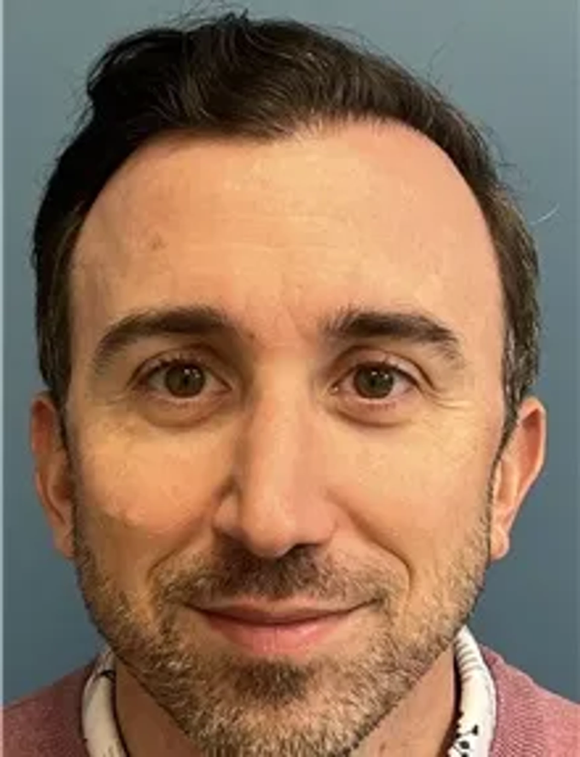 hair-transplant-after