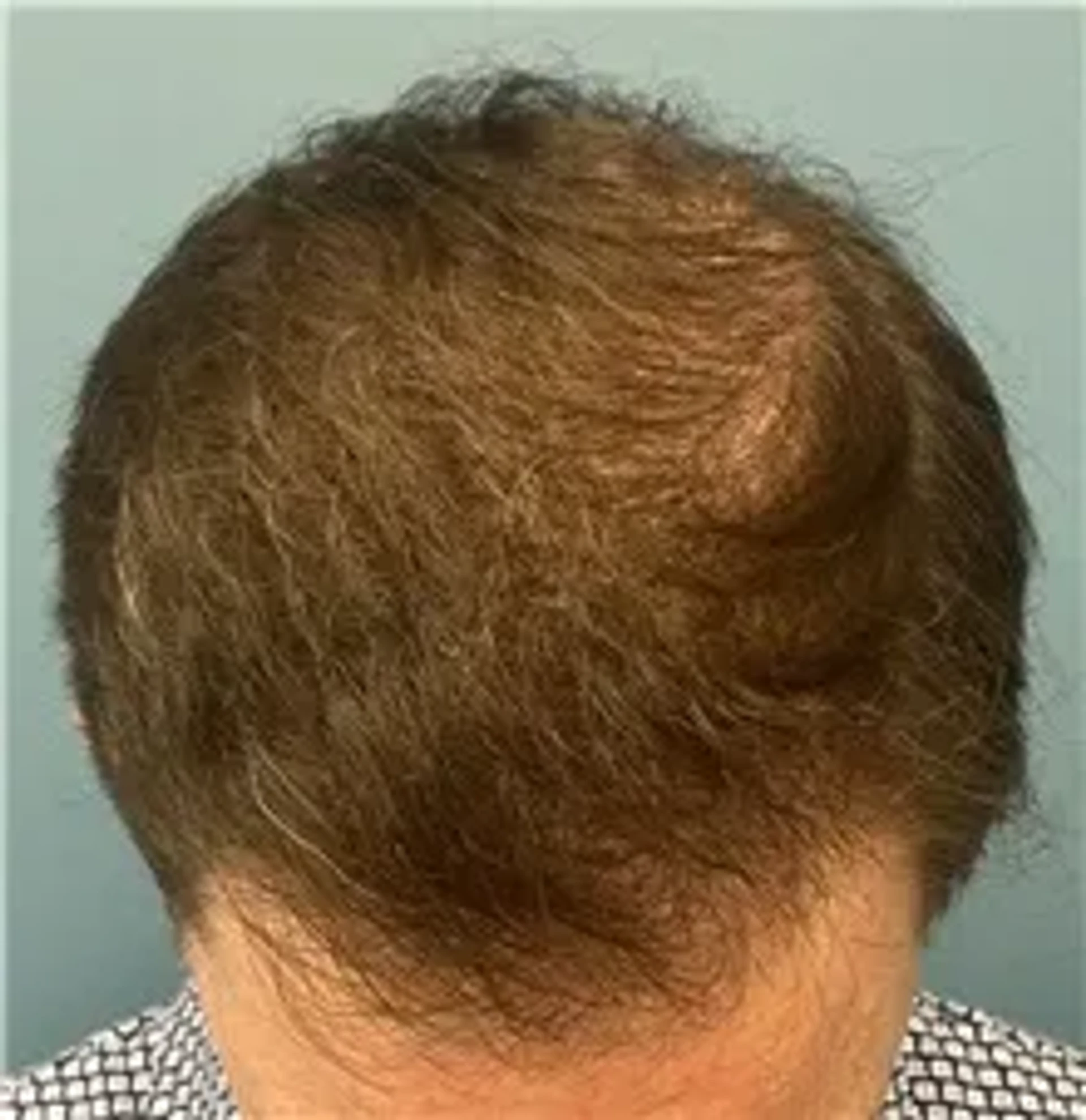 after-transplant