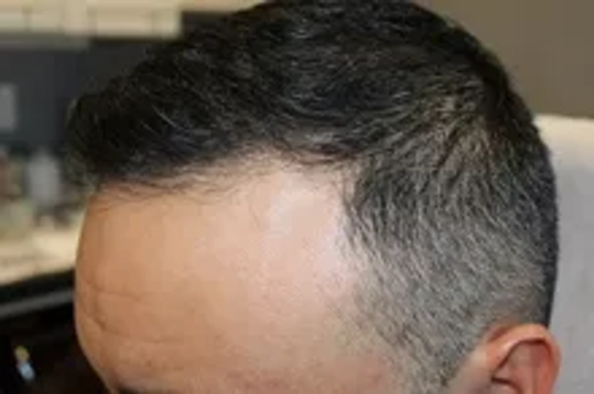 after-hair-transplant