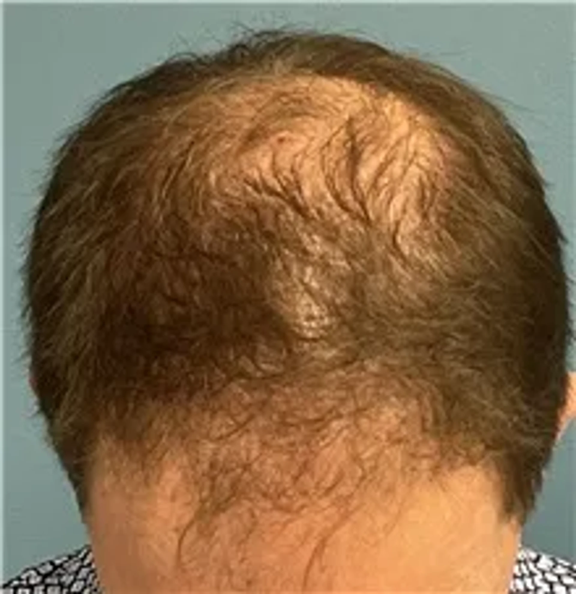 before-transplant
