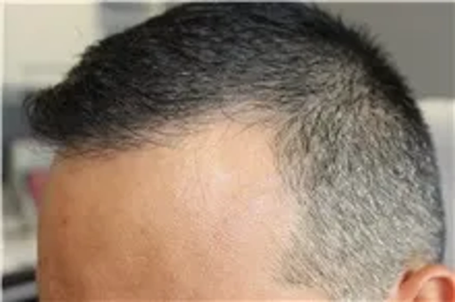 before-hair-transplant