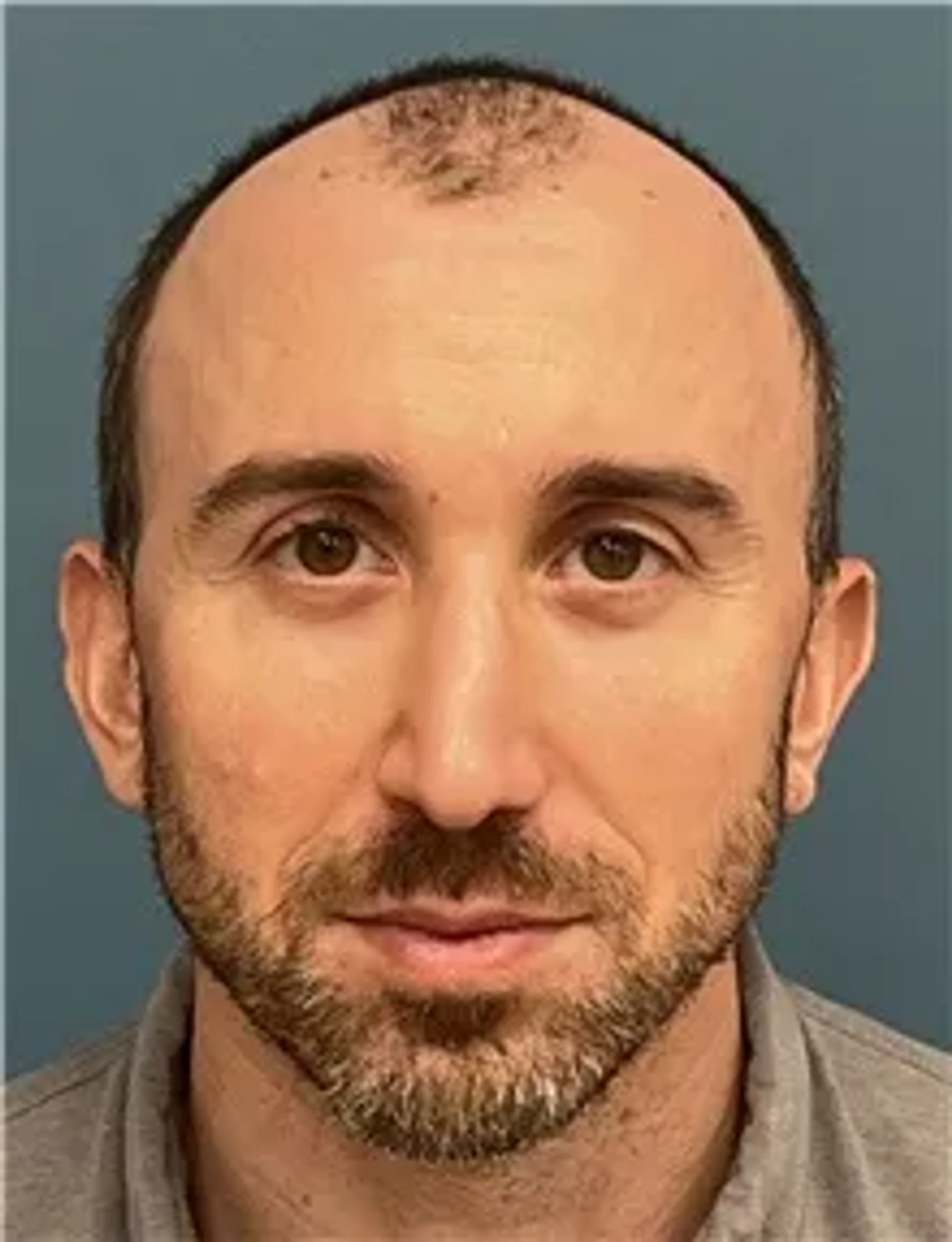hair-transplant-before