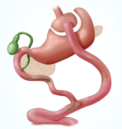 gastric-bypass-1 (1)