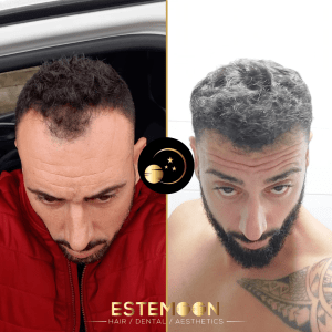 Pourquoi les gens vont-ils en Turquie pour une greffe de cheveux ?