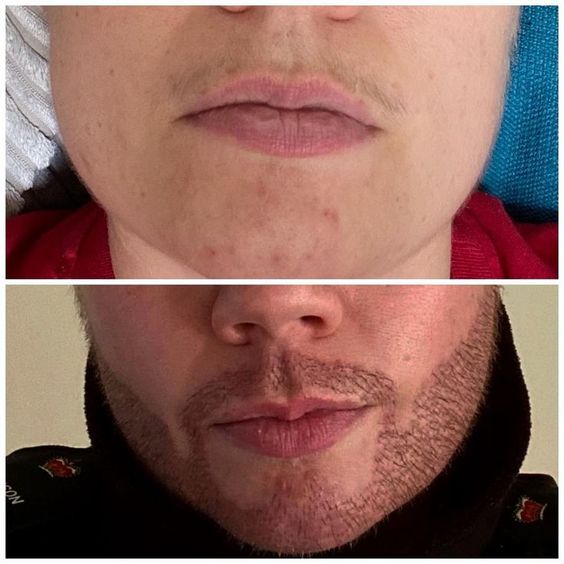 Beard Transplant in Albania: The Ultimate Guide to Restoring Your Facial Hair