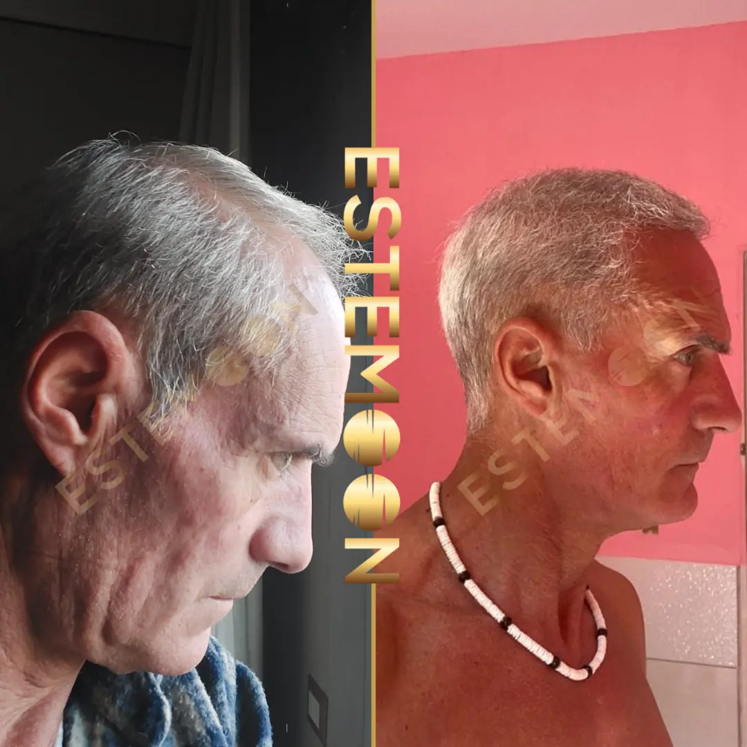 Hair Transpant Before and After