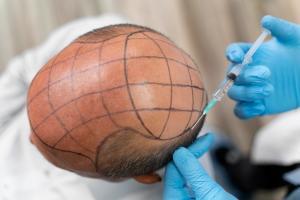 Saphire FUe hair transplant Turkey cost