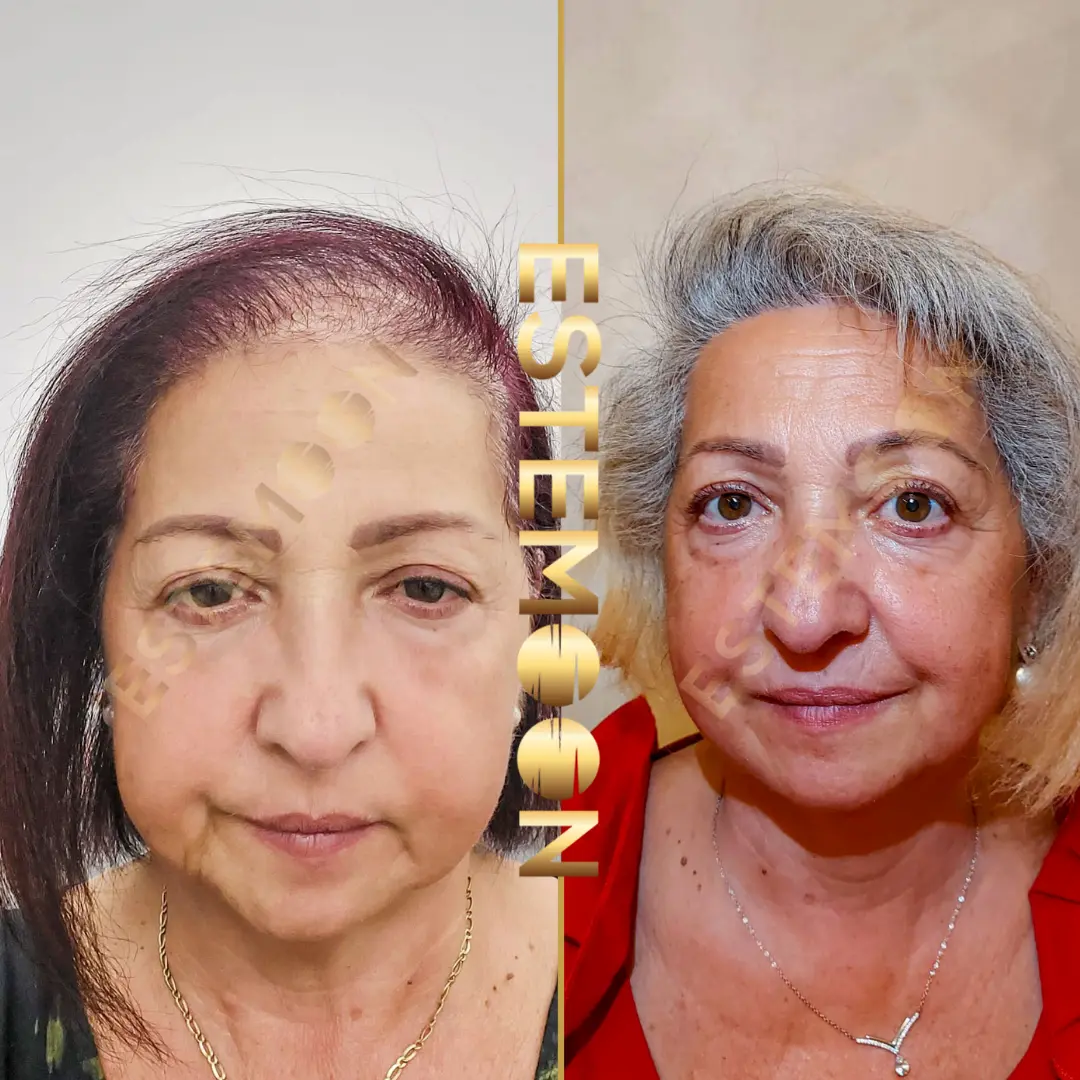 Woman Hair Transplant