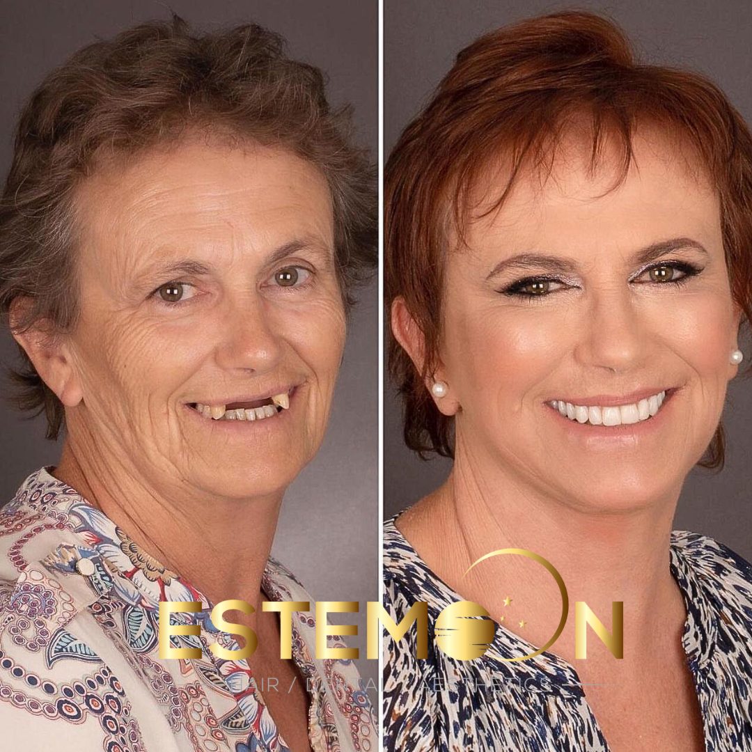 Smile Makeover in Albania: Transform Your Smile Affordably and Professionally