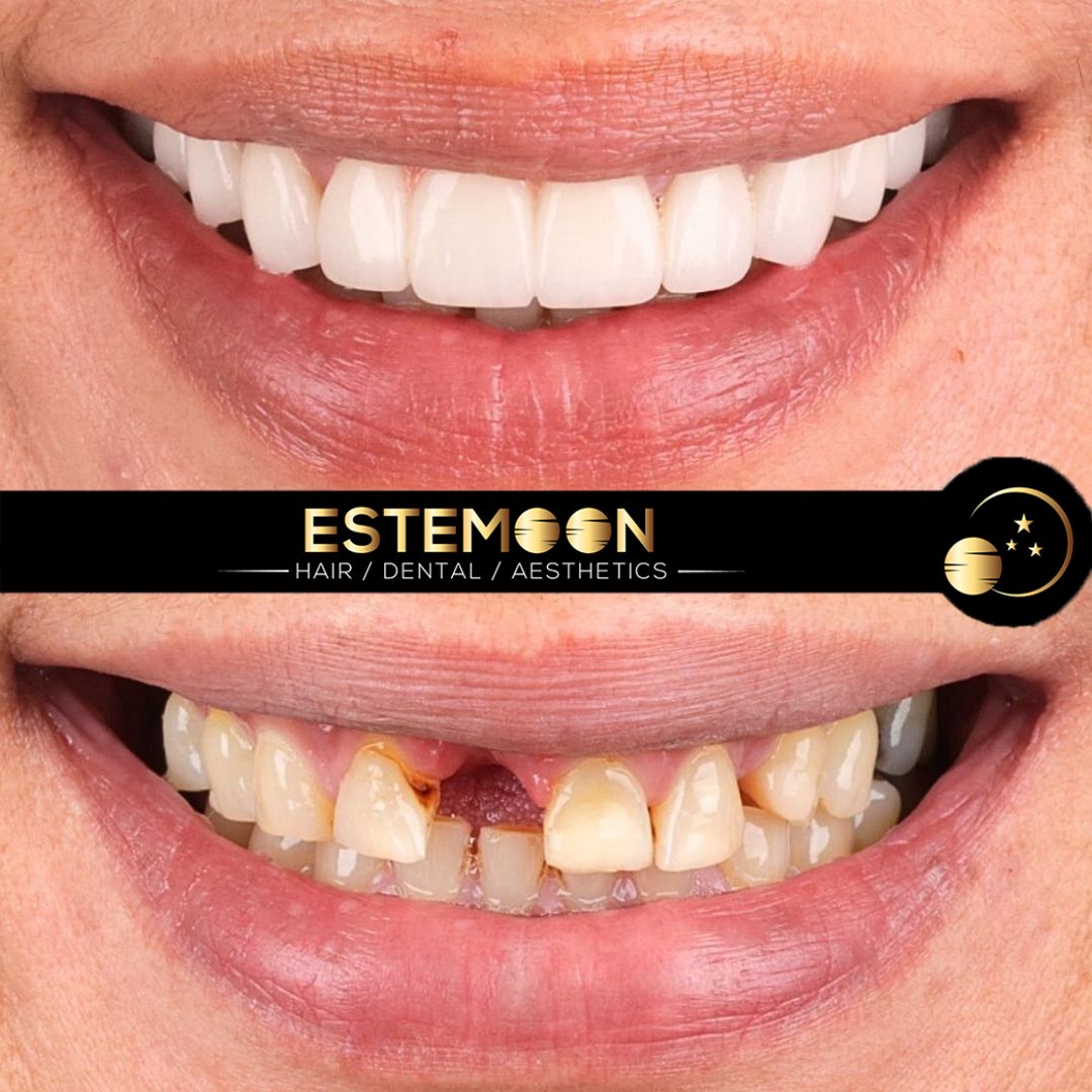 Zirconium Crowns in Turkey: The Ultimate Guide to Affordable and High-Quality Dental Care