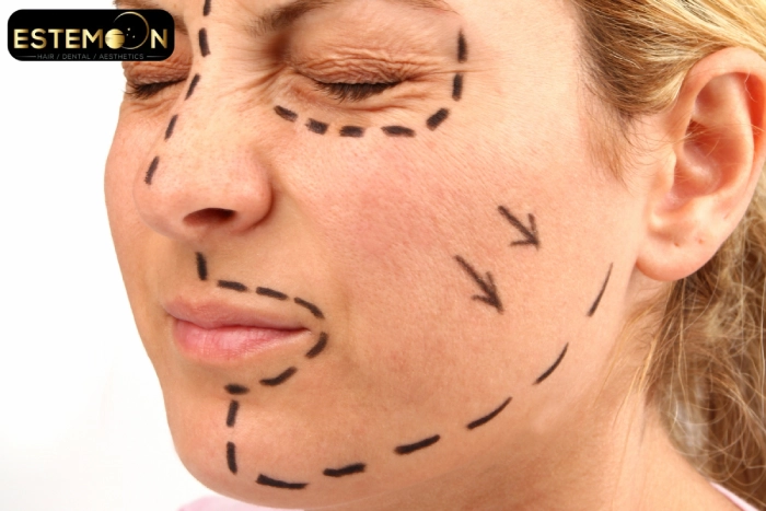 Facelift Surgery in Turkey