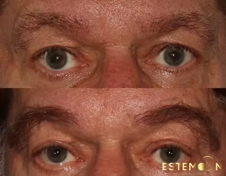 eyebrow hair transplant before after estemoon turkey