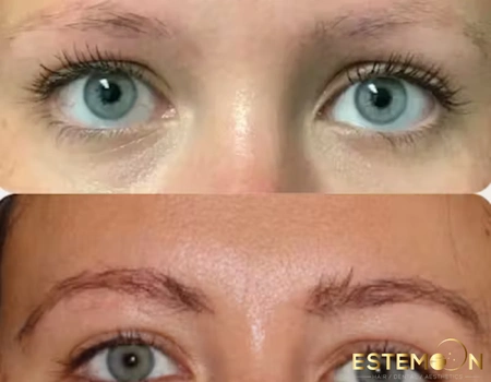 eyebrow hair transplant before after gallery estemoon