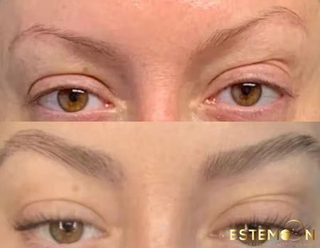 eyebrow hair transplant before after images