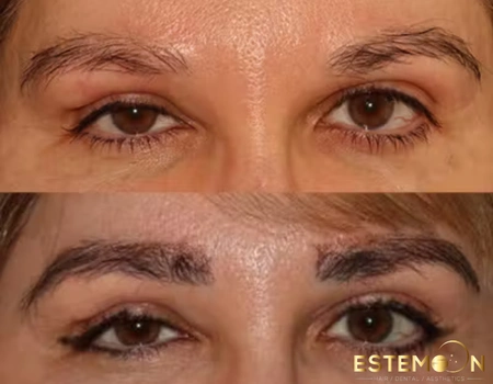 eyebrow hair transplant before after in turkey