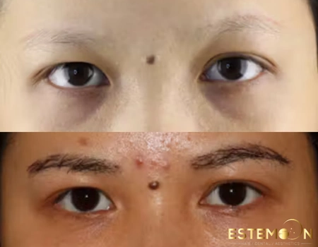 eyebrow hair transplant before after