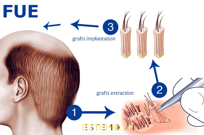 FUE hair transplant is work in Turkey