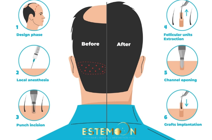 how FUE hair transplant is work in Turkey