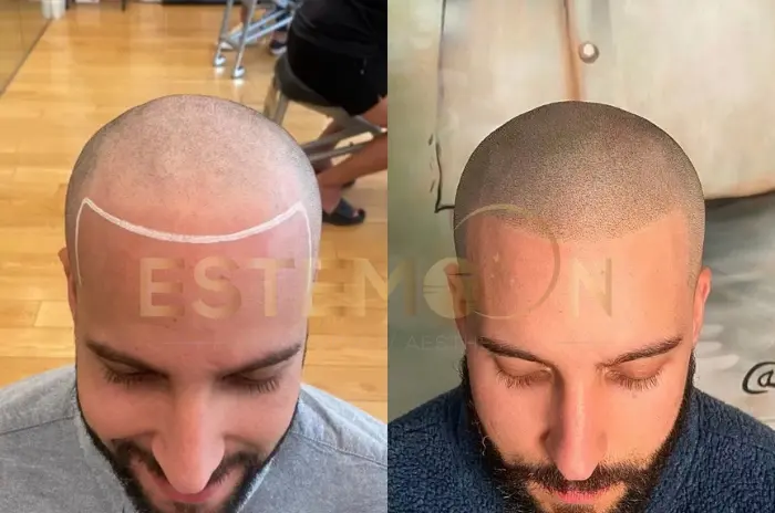 Hair Transplant in Turkey