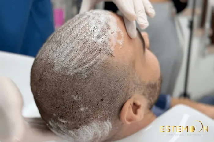 hair transplant