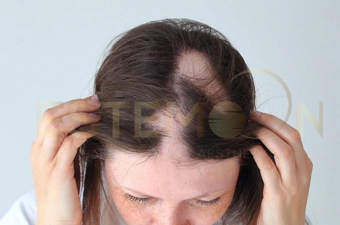 Autoimmune hair loss
