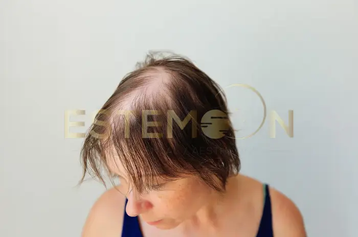 Does Wegovy cause hair loss