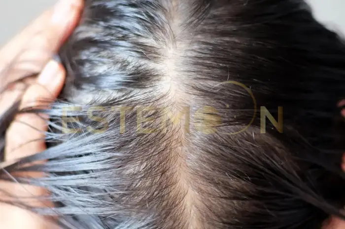 Does Wegovy cause hair loss What is the solution