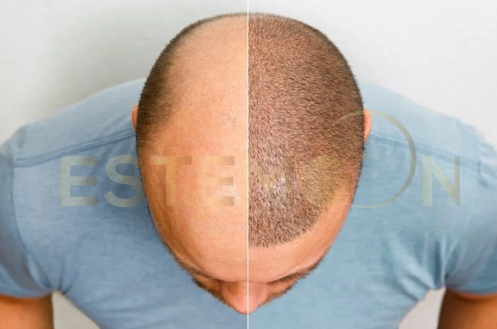 Hair cloning vs hair transplant