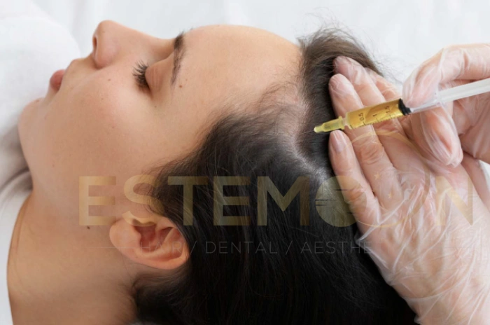 PRP hair injections