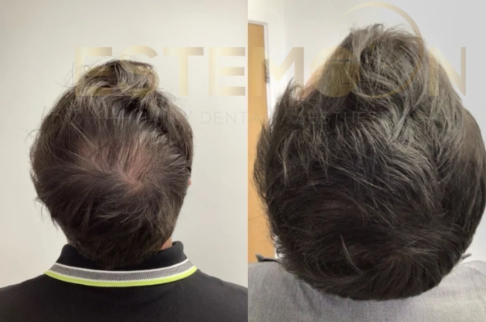 PRP hair therapy before and after