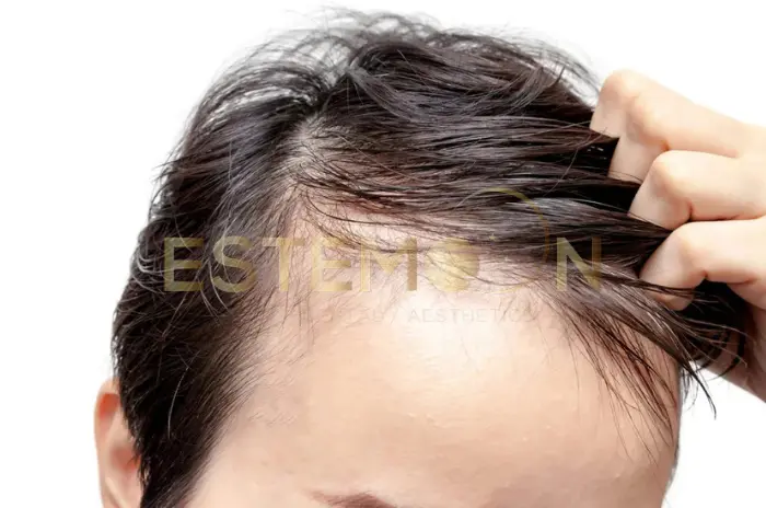 Stress and hair loss - Is there a connection between them