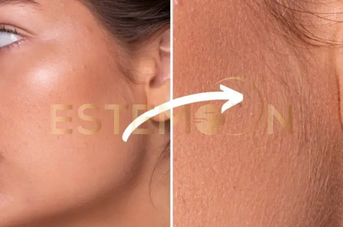 Vellus Hair Guide Peach Fuzz