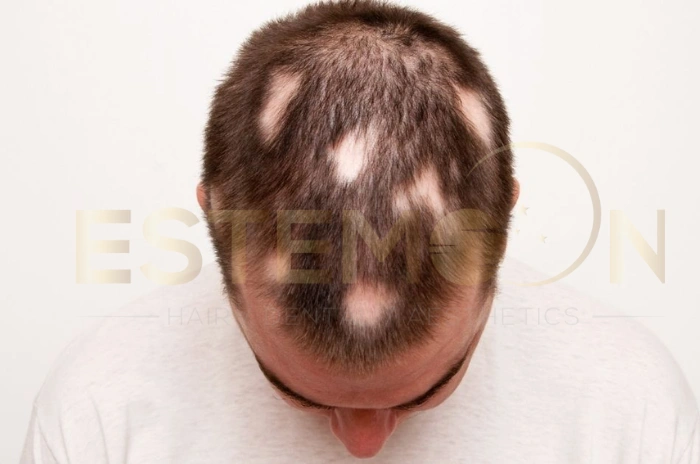 What is alopecia areata
