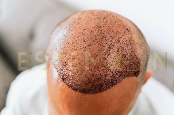 celebrity hair graft numbers