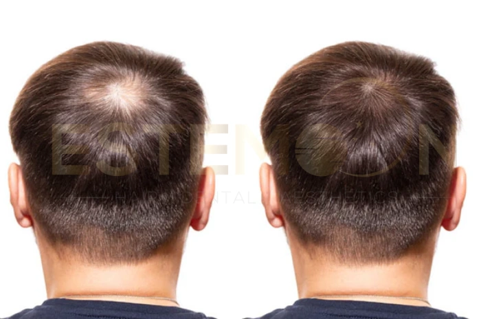 dutasteride vs finasteride