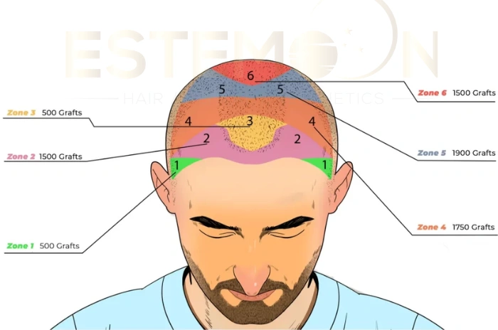 hair graft requirements by area