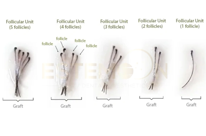 maximum grafts in one session