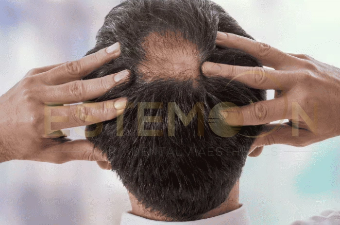 scarring alopecia treatment