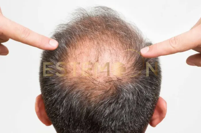 stress and hair loss