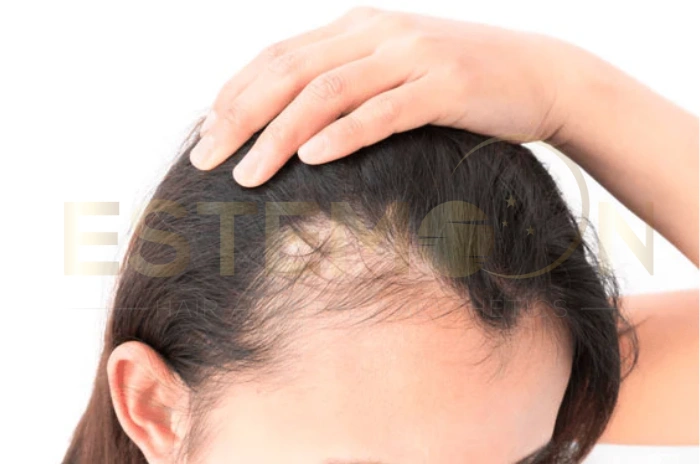 stress hair loss
