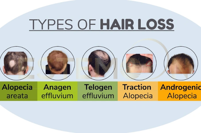 types of hair loss from stress