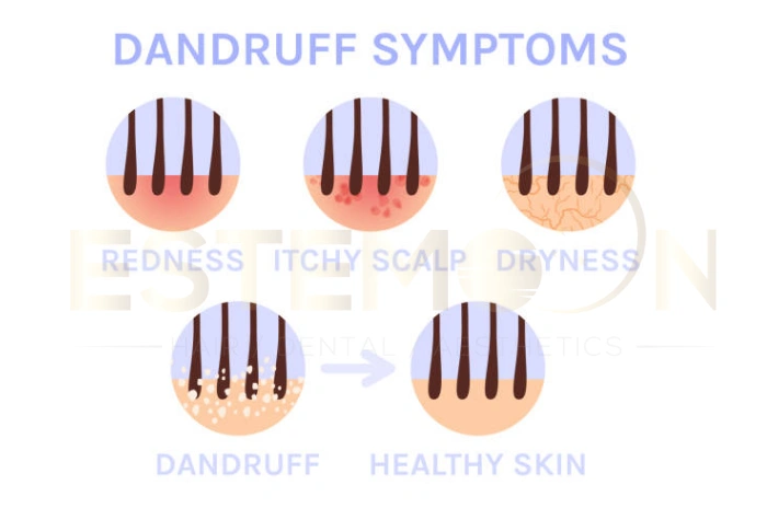what causes dandruff